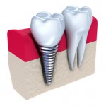 dental implants