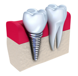 dental implants