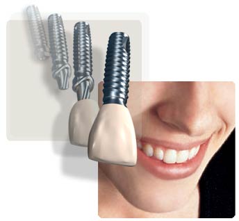single tooth implant
